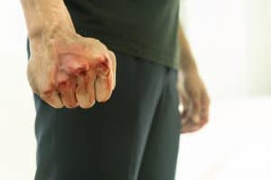 Will I Go to Jail for an Assault in Florida?
